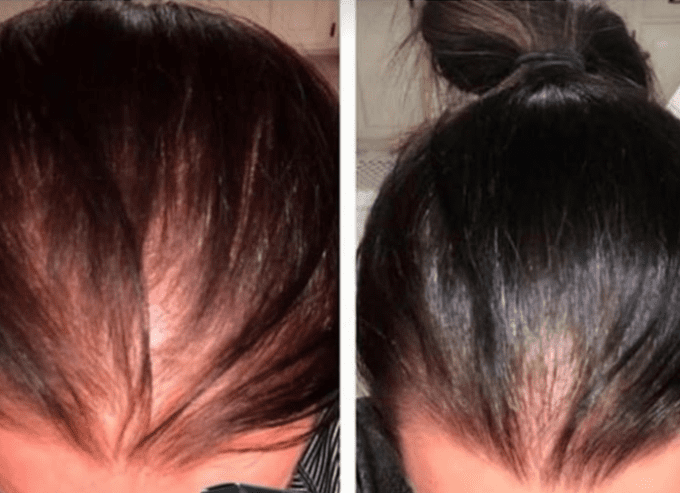 minoxidil  pour cheveux cassant